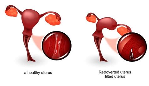 retroverted uterus in tagalog|Retroverted Uterus (Tilted Uterus): Cause, Symptoms, .